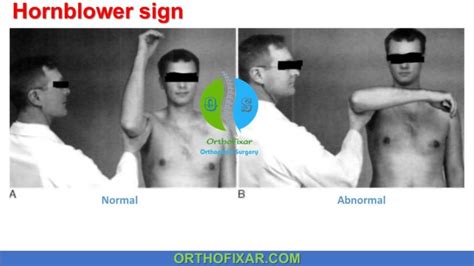 the drop shoulder test|positive hornblower's sign.